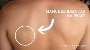 Read more about the article Manchas brancas na pele: cuidados e diagnóstico