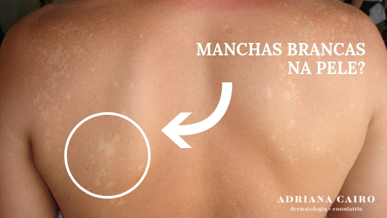 You are currently viewing Manchas brancas na pele: cuidados e diagnóstico
